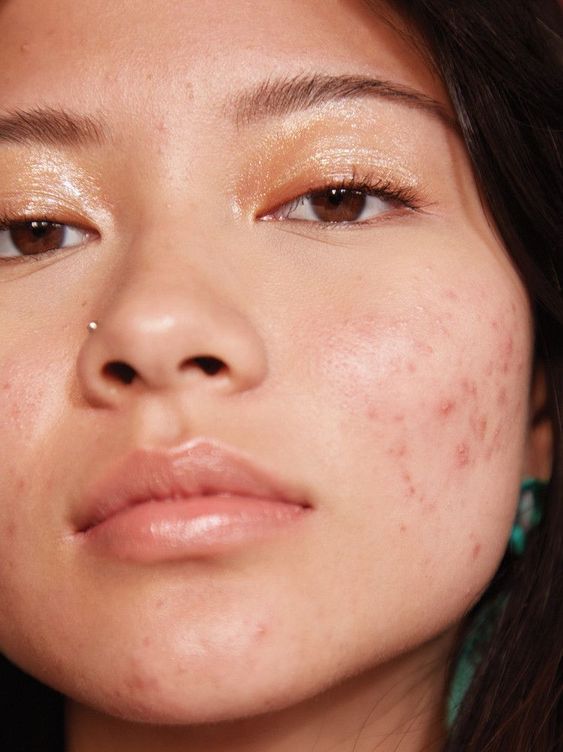 Acne 101 - Causes, Tips and Routine to Help Ease Breakouts